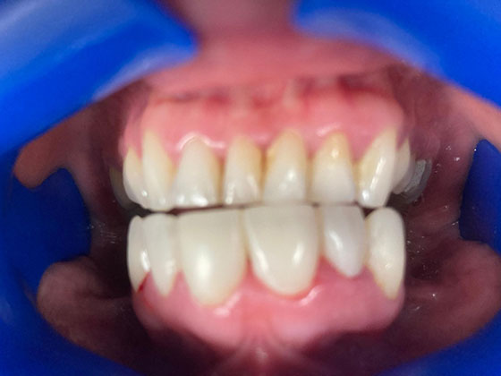 First-dentures