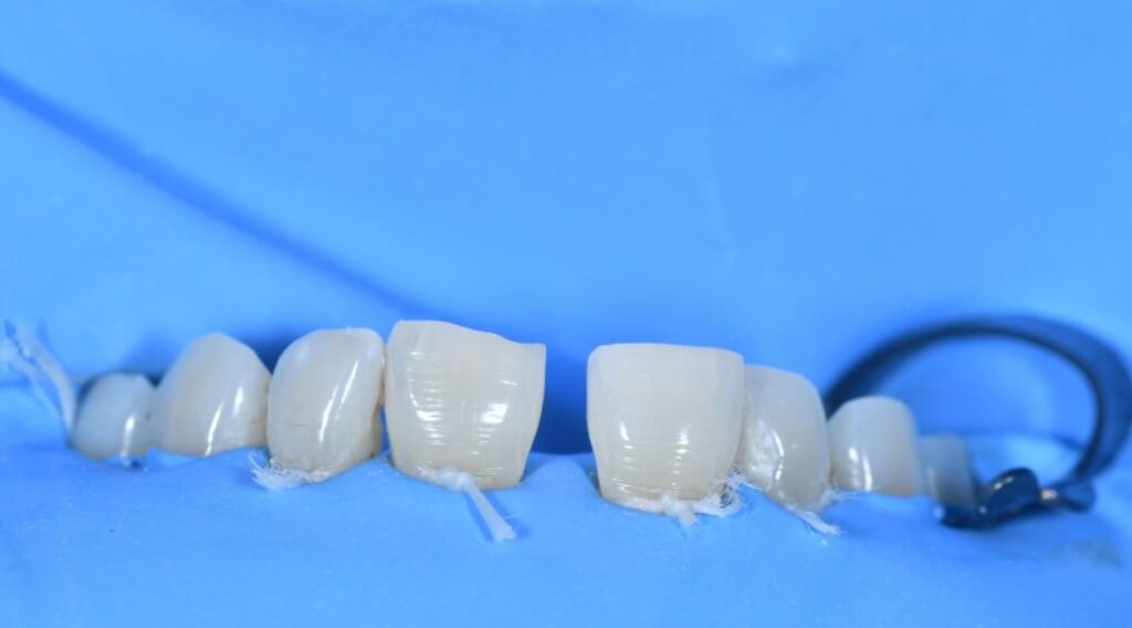 Dentures FAQs
