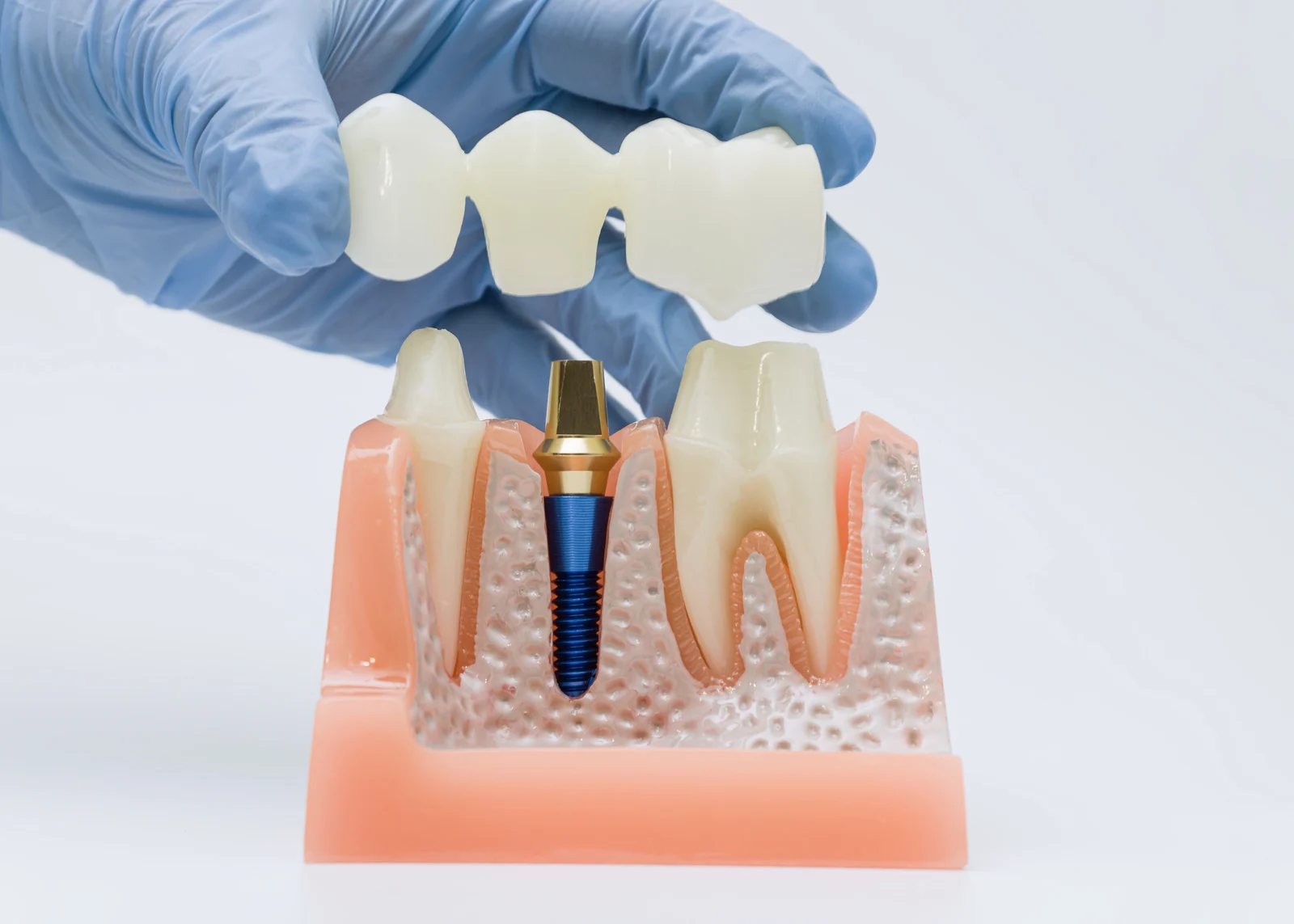 Implant-supported dental bridge fitted onto a dental implant abutment replacing a missing tooth