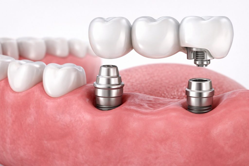 Dental bridge supported by two implants in the lower jaw at Wolverhampton dental clinic