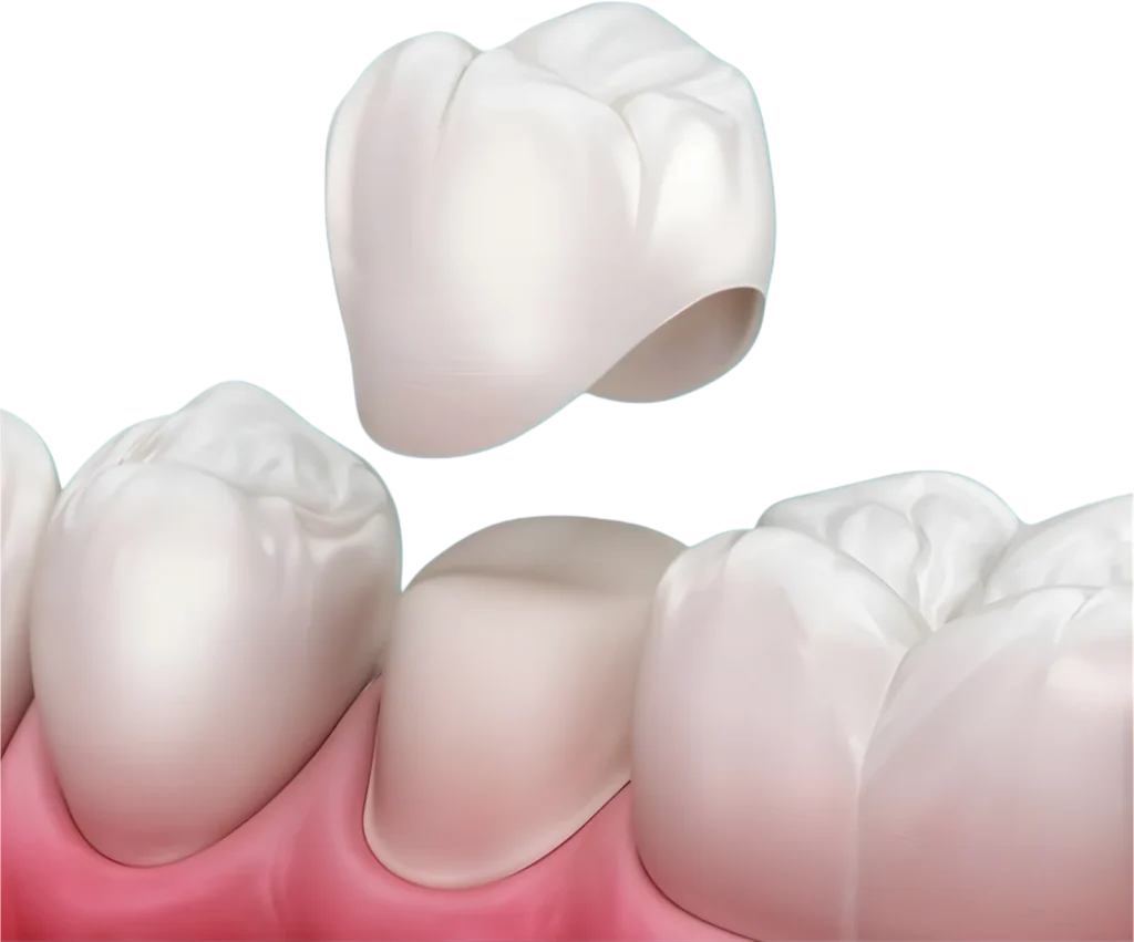 illustration of dental crown restoration