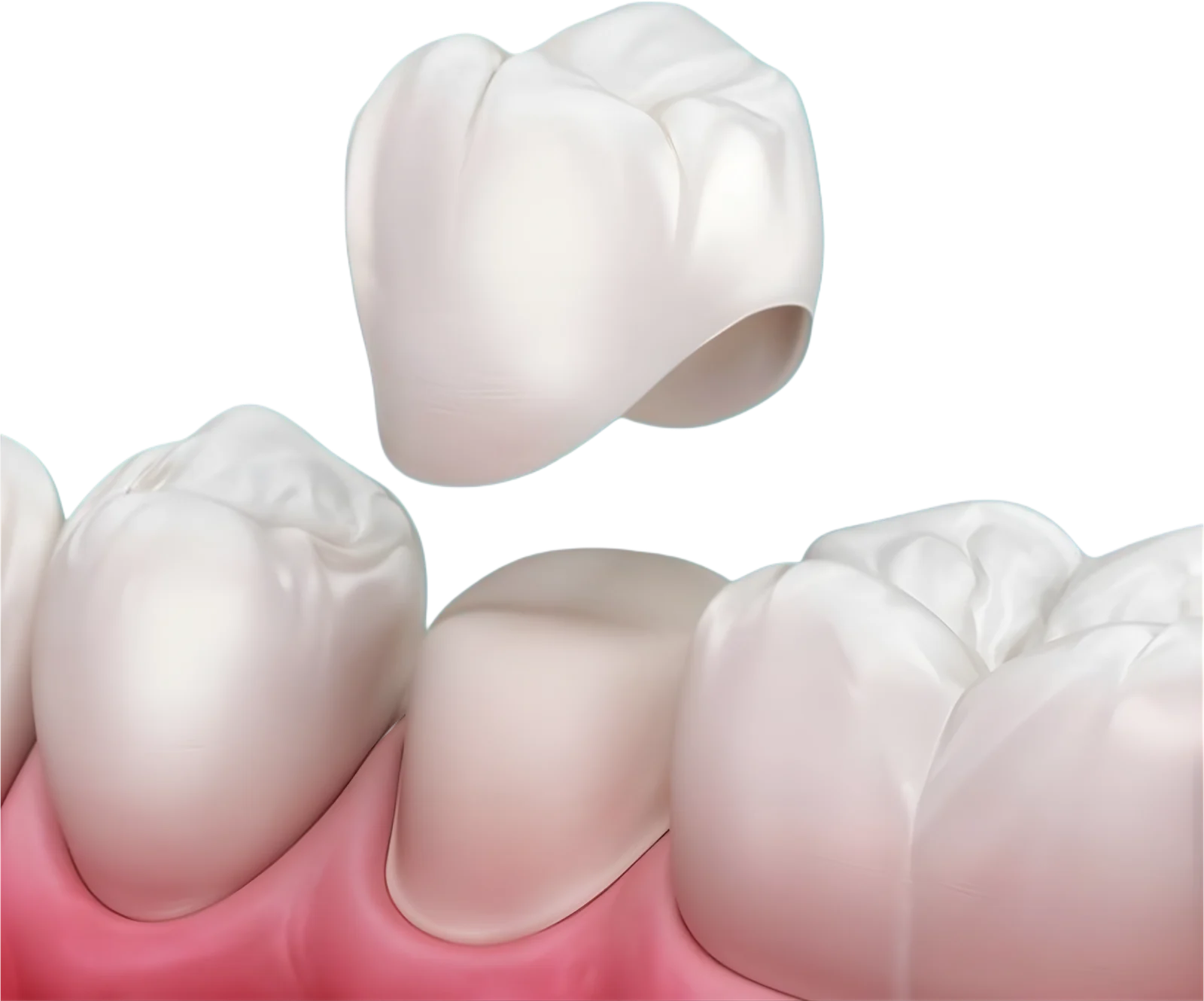 illustration of dental crown restoration