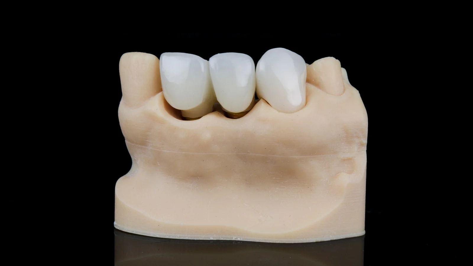 dental crowns model in a dental clinic wolverhampton
