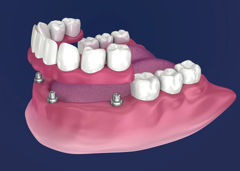 Diagram of an implant-retained lower denture attached to dental implants in the jawbone, the longest-lasting denture