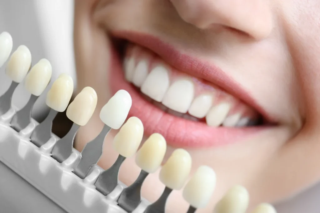Dental shade guide compared against teeth to match colour before teeth whitening or veneers treatment