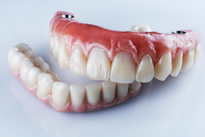 Implant-retained upper denture with attachment housings next to a conventional full lower denture