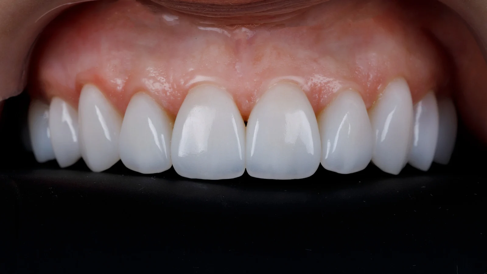 Close-up of finished porcelain veneers showing a natural, symmetrical smile in Wolverhampton
