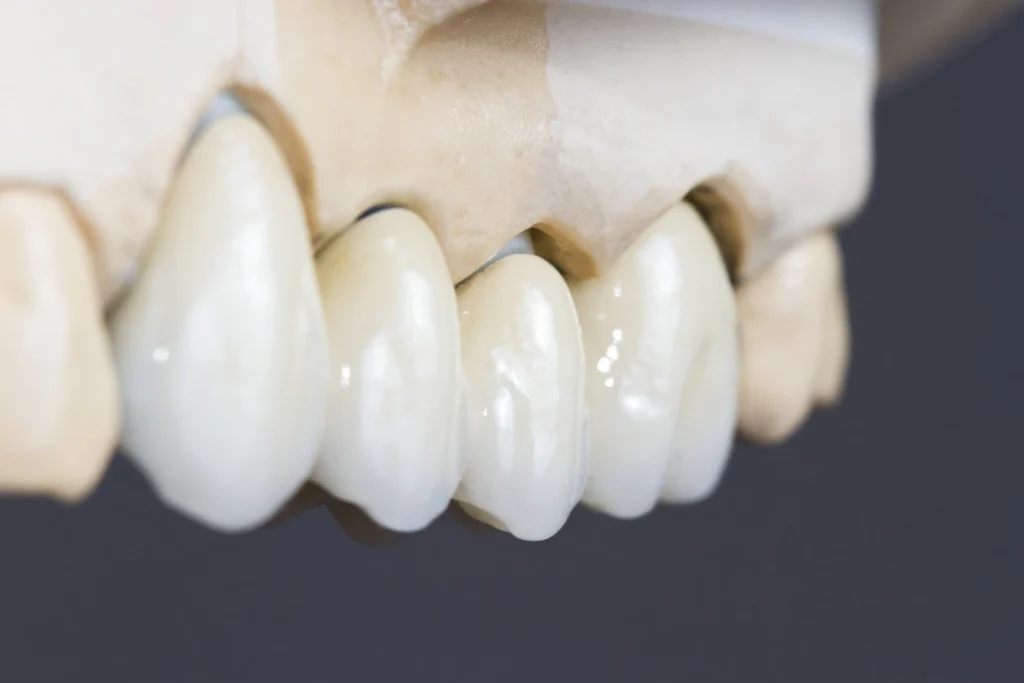 Close-up of a dental bridge fitted on a dental model showing a natural tooth-colored finish