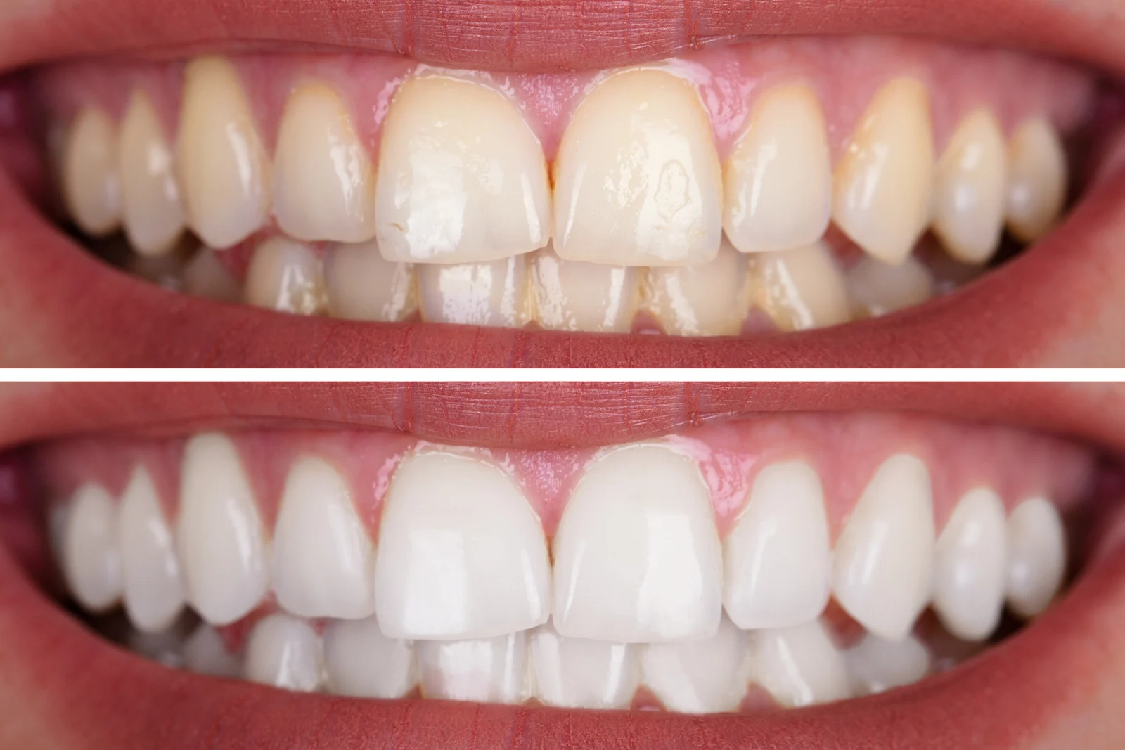 teeth whitening before and after dental clinic snapfit denture practice