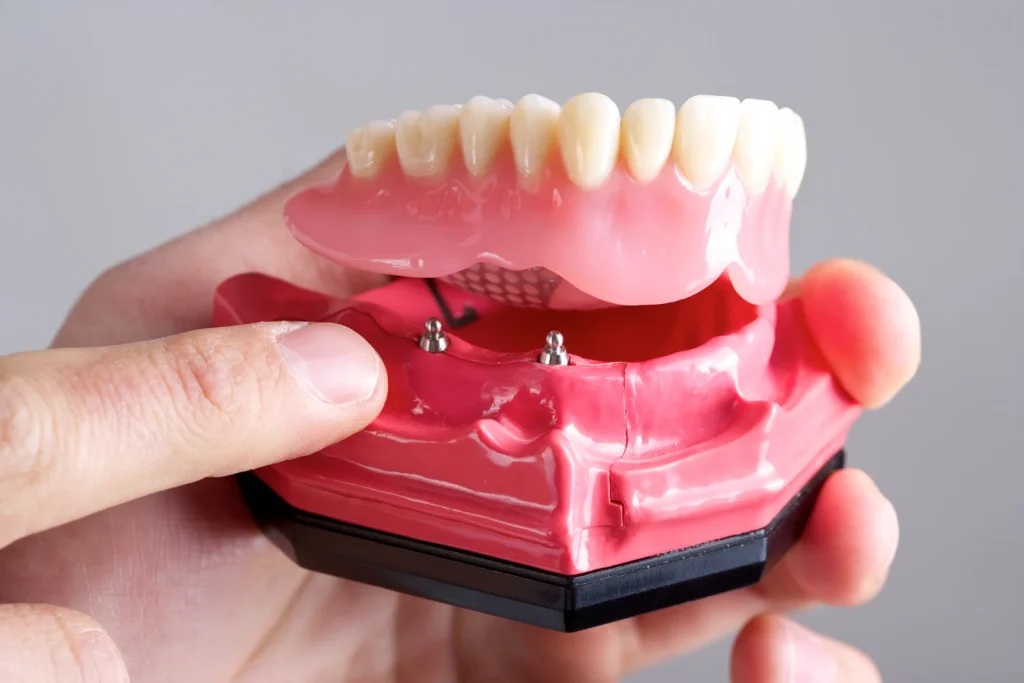 snap-in dentures timeline in wolverhampton and west midlands